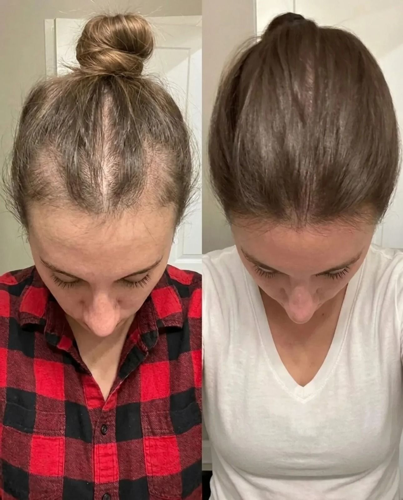 Before and after — Crown coverage with hair tied back — the hardest angle to fake. 0 → 20 weeks of daily pumpkin seed oil